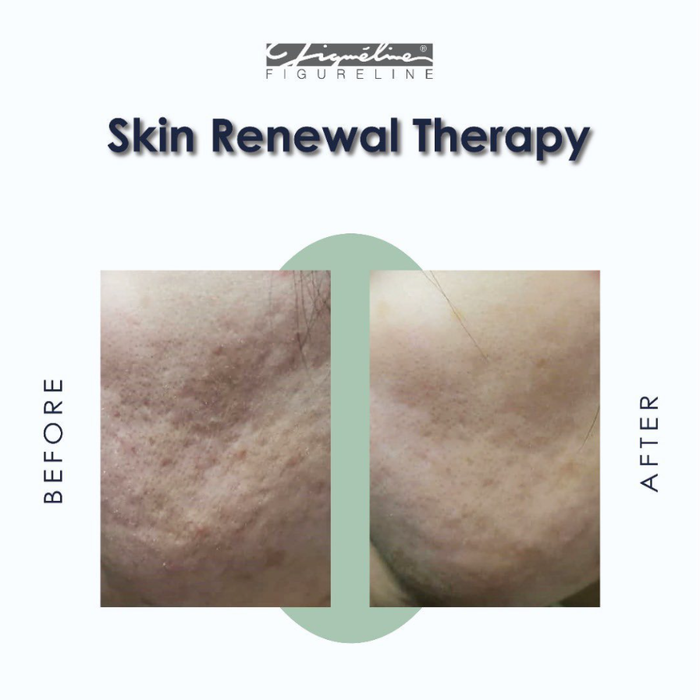 Skin Renewal Therapy